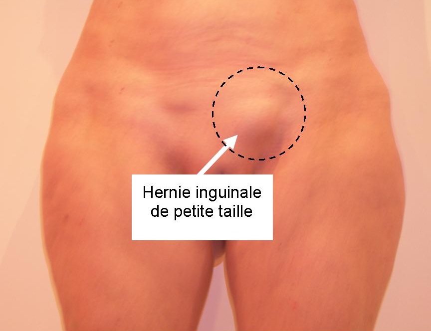 Photo hernie inguinale