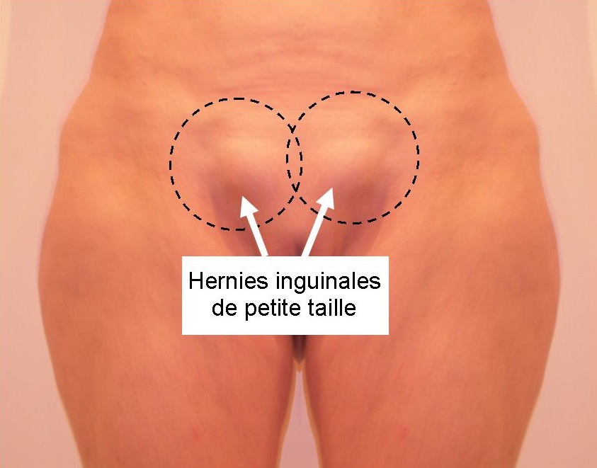 Photo hernies inguinales